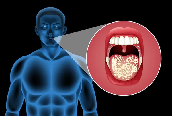 Mouth Cancer